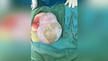 برداشتن لوله و تخمدان یک طرف در خانم جوان مبتلا به تومور بوردرلاین بزرگ تخمدان